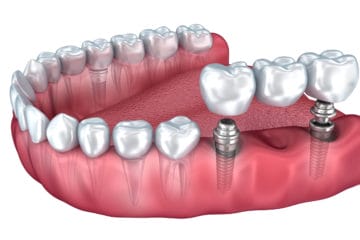 Dental Implants Are a Popular Choice to Replace Missing Teeth